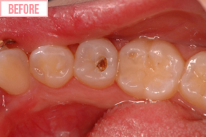 強化プラスチック充てんbefore