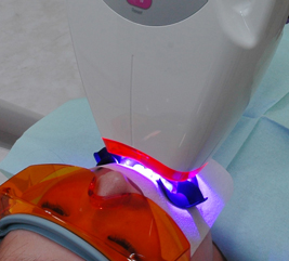 ホワイトニングのイメージ