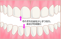 それぞれの歯を少しずつ削り、歯並びを綺麗に