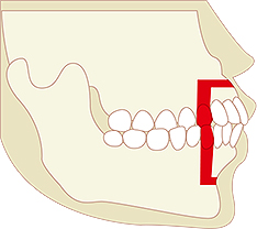 出っ歯・受け口の治療