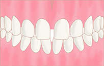 すきっ歯(空隙歯列)イメージ