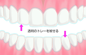 透明のトレーを被せるafter