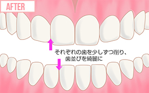 それぞれの歯を少しずつ削り、歯並びを綺麗に
