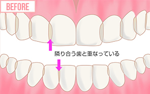 隣り合う歯と重なっている