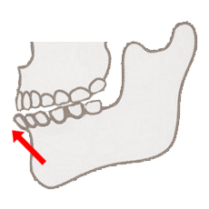 歯の向きによる受け口