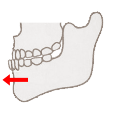 骨の位置による受け口