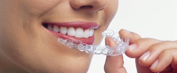 インビサライン装着イメージ