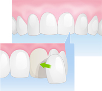 ラミネートべニア