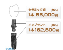 エステティックインプラント(ツーピース)2回法